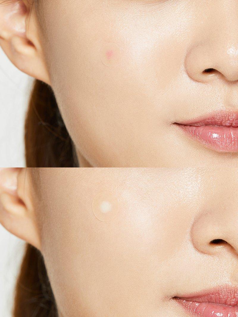 COSRX Acne Pimple Master Patch – 24 Patche