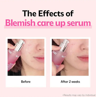 ISOI Blemish Care Up Serum 35mL bottle with dropper, clear liquid inside, designed for blemish-prone skin.
